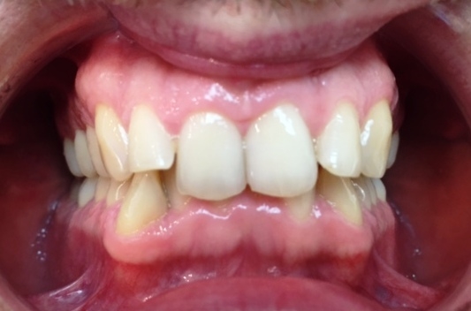Traitement orthodontie adulte d’une supraclusion par aligneurs avant