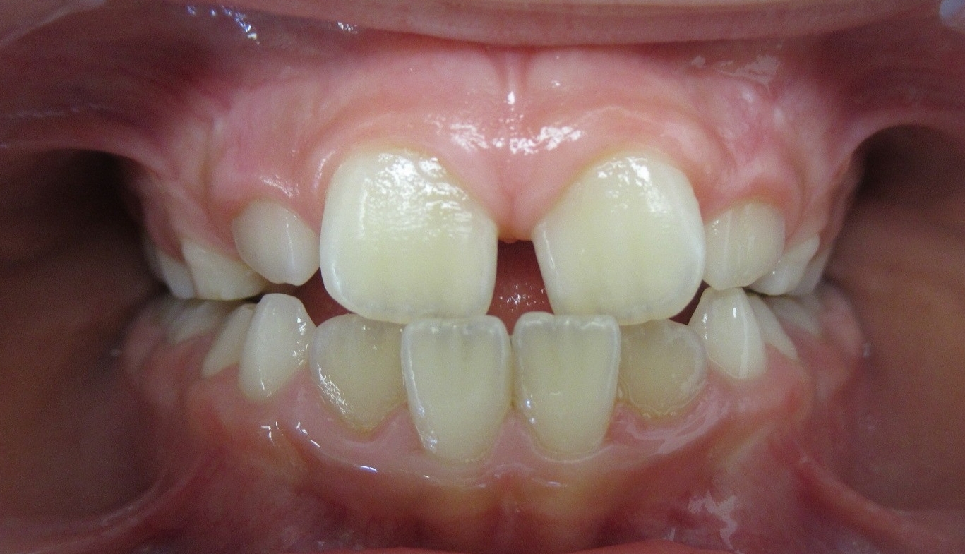 Avant orthodontie Invisalign First 6 mois d’aligneurs pour correction des axes